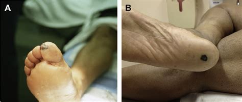 Acral Lentiginous Melanoma On The Great Toe A And Sole Of The Foot Download Scientific