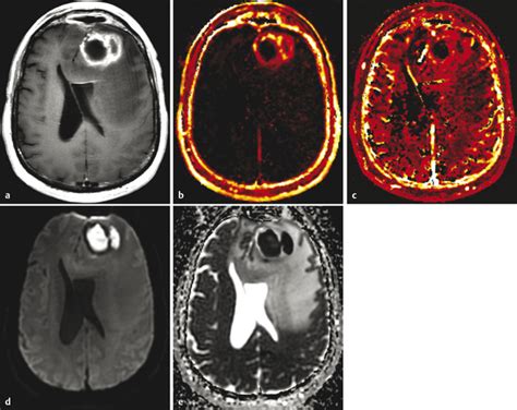 5 Perfusion Imaging Dynamic Contrast Enhanced T1 Weighted Mri Dce Mri