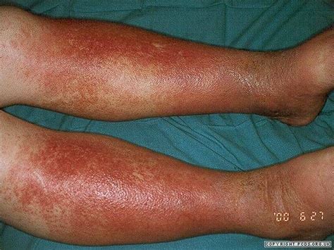 Gravitational Eczema Is A Common Form Of Eczema That Occurs On The