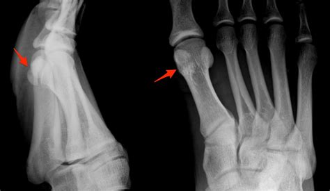 Sismoid Bone Computed Tomography Shows Fracture Of Sesamoid Bone A