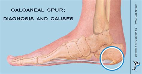 Diagnosis Causes And Treatments Of Heel Spurs