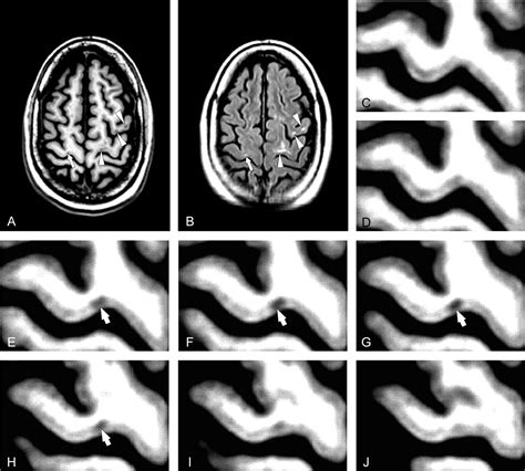 In Vivo Detection Of Cortical Plaques By Mr Imaging In Patients With