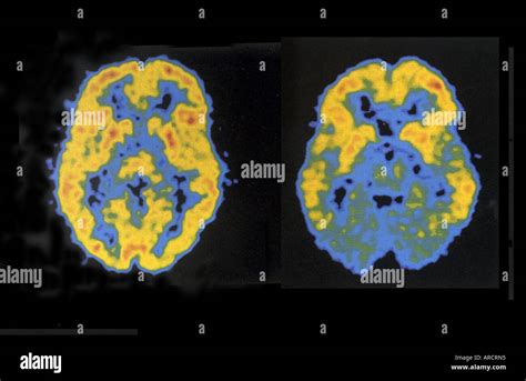 A Pair Of Pet Scans Showing Normal Left And Reduced Right Brain