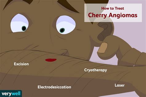 Cherry Angioma Symptoms Causes Diagnosis Treatment