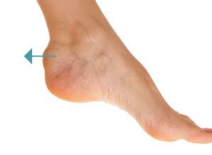 In some instances, haglund's deformity can lead to bursitis, a more serious condition. Deformidad de Haglund | Clínica María del Mar Ruiz