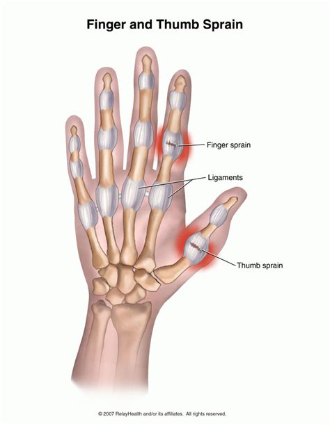 Thumb Sprain Ulnar Collateral Ligament Singapore Orthopaedic Clinic