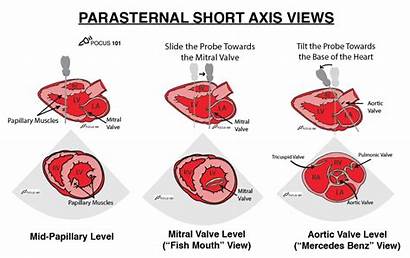 Cardiac Ultrasound Echocardiography Parasternal Short Axis Pocus