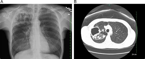 Mycobacterium Kansasii Infection In A Patient Receiving Biologic