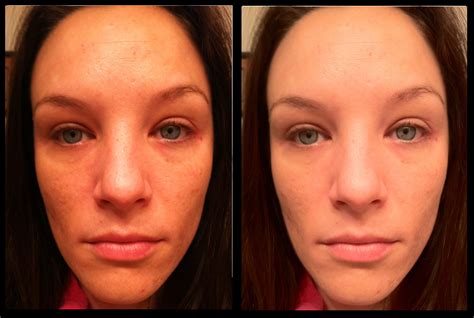My Results 3 Months Of Tretinoin For Acne