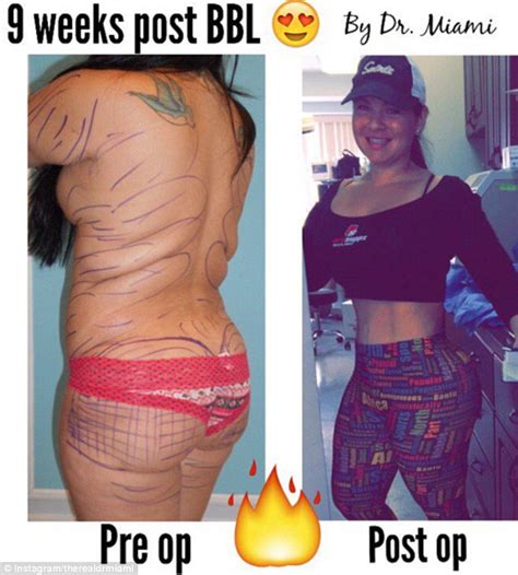 Dr Miami Finds Fame After Posting Graphic Before And After Plastic
