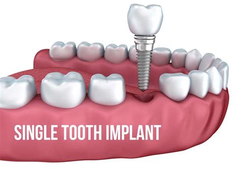 Implant Teeth Prices Dental News Network