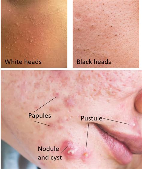 Acne Awareness And Understanding Dr Varsha Health Solutions