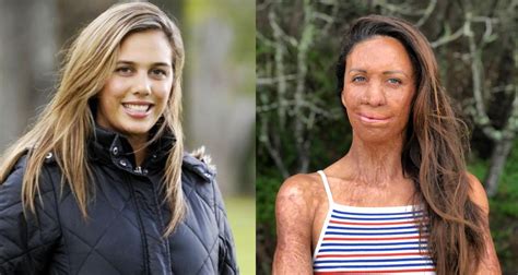 Turia Pitt S Story — Her Recovery From 65 Burns Thenetline