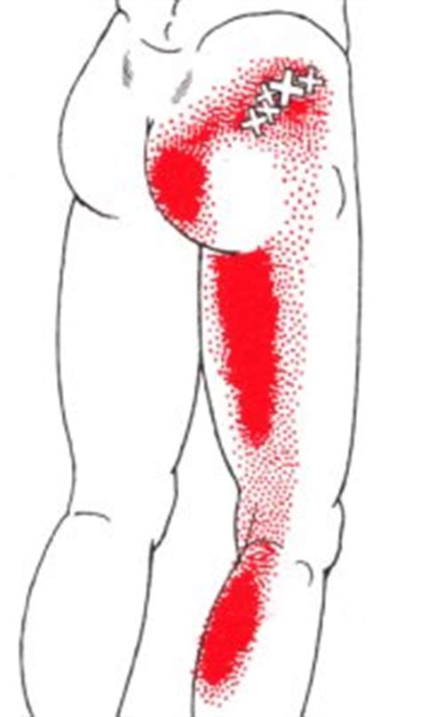 The gluteus maximus muscle, gluteus erectors (long muscles next to your spine), latisimus dorsi (wide muscle covering your lower back), quadratus laborum (deep muscle under. Hip Pain | Sciatica | Leg Pain