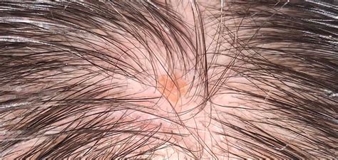 This Has Been On My Scalp For About A Year Really Concerned About It