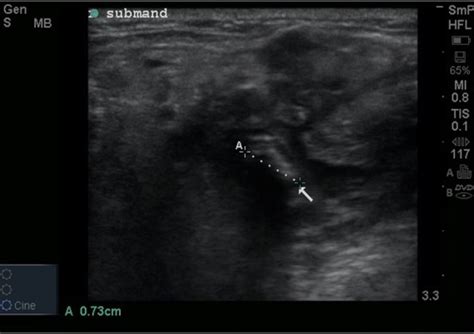 Point Of Care Ultrasound Diagnosis Of Acute Sialolithiasis With