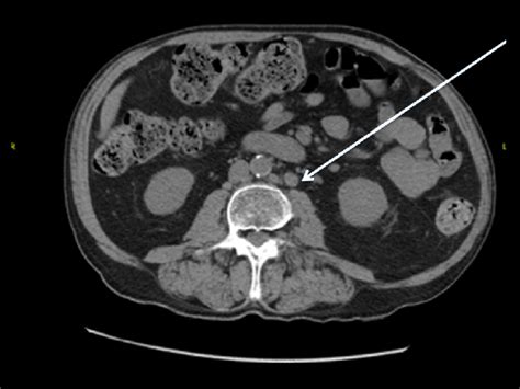 Ct Scan Showing The Para Aortic Lymph Node Enlargement Arrow