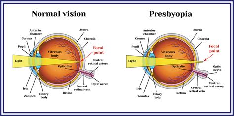 Presbyopia Azar Eye Clinic