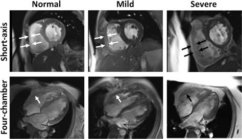 Right Ventricular Rv Hypertrophy In Pulmonary Arterial Hypertension