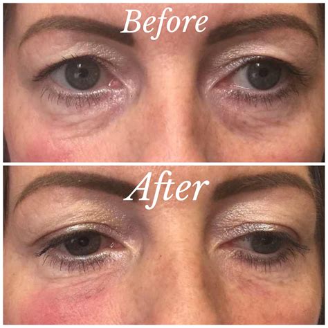 Tear Troughs With Teosyal Redensity Ii — Visage Aesthetics