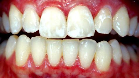 What Are The White Spots On Your Teeth White Choices