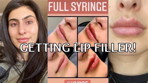 I Got Lip Filler Before After And Healing Process Restylane Kysse