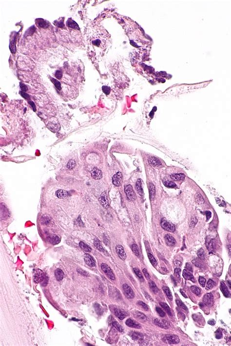 Squamous Metaplasia Of The Uterine Cervix Libre Pathology