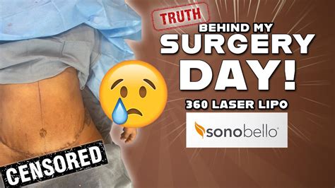 The Truth Behind My Surgery Day Sono Bello Laser Lipo Before And