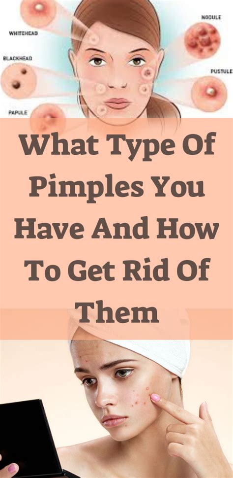 What Type Of Pimples You Have And How To Get Rid Of Them Natural