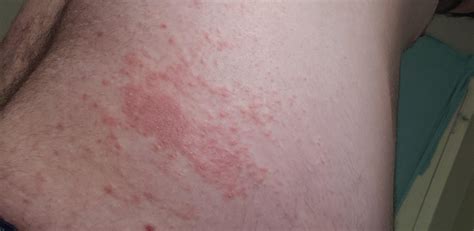 What Is This Rash It Started On My Hips But Has Now Spread To My Arms