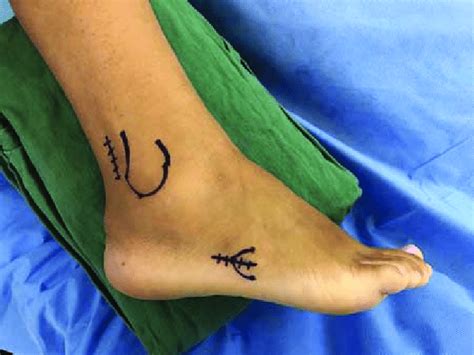 Preoperative Skin Marking Of The Proximal And Distal Incisions The