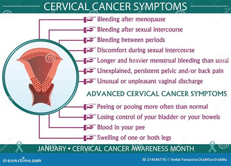 Cervical Cancer Symptoms Infographic Vector Illustration Stock Vector Illustration Of Care