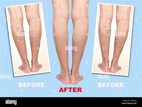 Treatment Of Varicose Before And After Varicose Veins On The Legs
