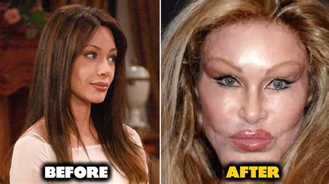 The Bold And The Beautiful Actors Who Have Done Plastic Surgery Youtube