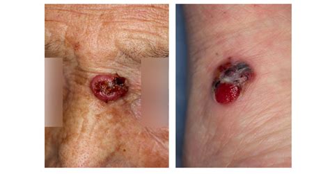 皮膚悪性腫瘍の病態と最新治療 メディカルノート