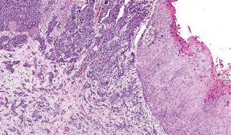 Pathology Outlines Merkel Cell Carcinoma