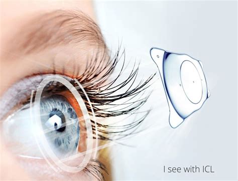The Evo Visian Icl Lens In Phakic Surgery