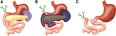 Pylorus Preserving Total Pancreatectomy For Intraductal Papillary