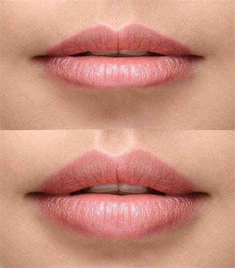 Fillers Best Prices For Lip Fillers And Whole Face Contour