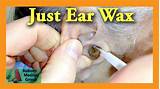 Pictures of Ear Wax Doctor Near Me