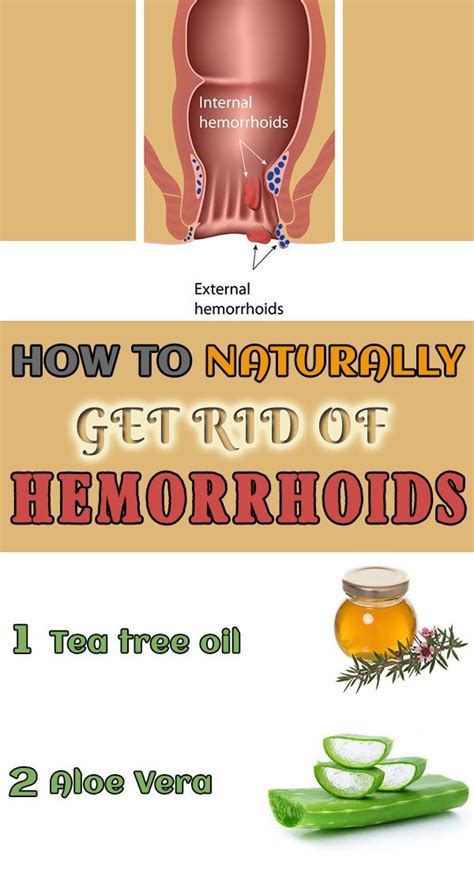 how to naturally get rid of hemorrhoids 10 home remedies discover how to cure hemorrhoids