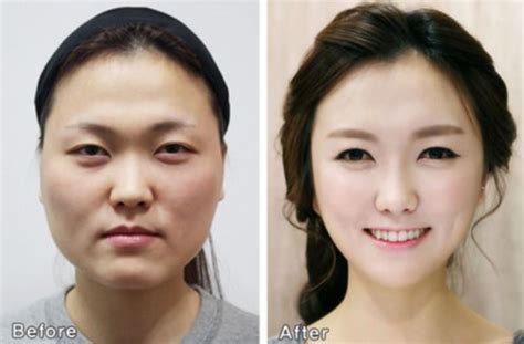 Plastic Surgery In South Korea That You Need A New Passport Western Eyes