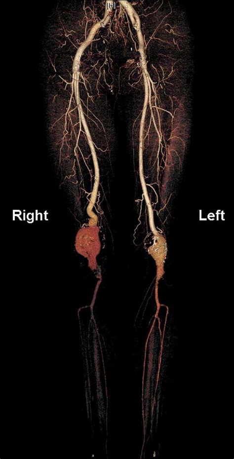 Bilateral Popliteal Artery Aneurysms In A Young Man With Loeys Dietz