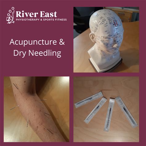 the differences between dry needling vs acupuncture river east physiotherapy