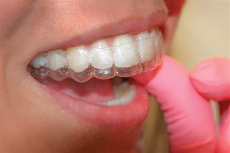 Dental Braces Vs Invisalign Pros And Cons Sgmedicaldirectory