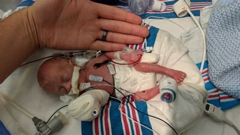 ‘miracle Baby One Of The Smallest Premature Infants Ever Heads Home