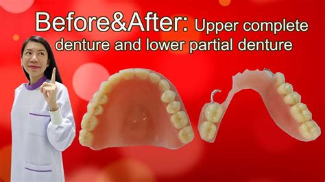 Beforeandafterupper Complete Denture And Lower Partial Denture Youtube