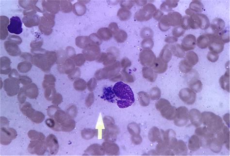Leishmania Donovani Ld Bodies Inside A Monocyte Wright Stain X 100
