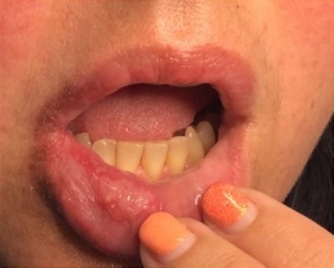 Figure 1 From Recurrent Blisters On The Lip Semantic Scholar