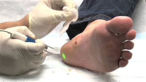 This is a strong acid, generally applied as a gel, that gradually dissolves layers of skin from the affected area, eventually resulting in complete removal of the wart. Plantar wart removal stages - How to get rid of warts fast ...